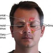 Sinus Infection Symptoms and Cure
