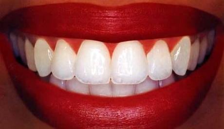 teeth whitening