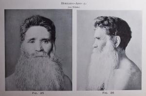 An old photo of a Hokkaido Ainu man, probably from the 19th Century. Note the Caucasoid phenotype. It was this resemblance that caused people to assign them to Caucasoids, but genetic tests later disproved this. Early anthropologists said the Ainu looked like 