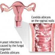 Yeast Infection Signs, Symptoms and Treatment