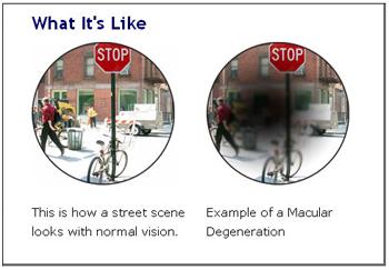 macular_degeneration