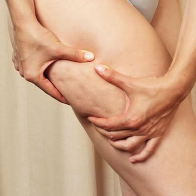 Fight back against cellulite!