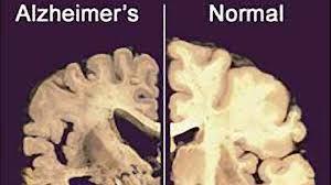 alz brain normal brain