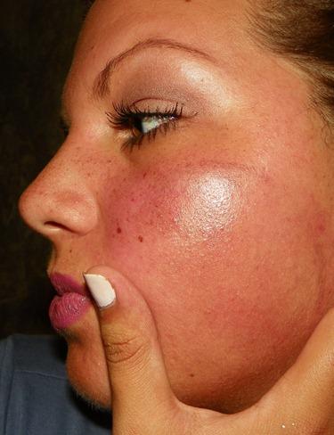 chemical burn on face treatment