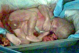 Remember  Kermit Gosnell And Women's Medical Society's  Victims, Babies A-G