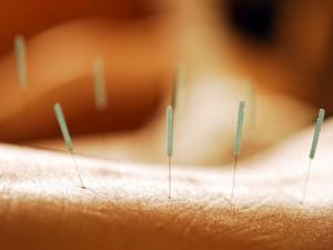 Weight loss through acupuncture