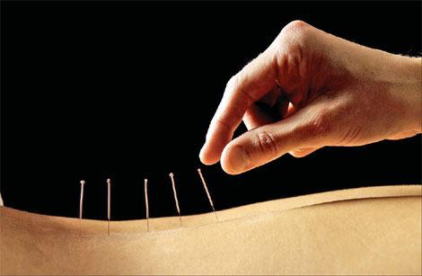 Acupuncture for weight loss