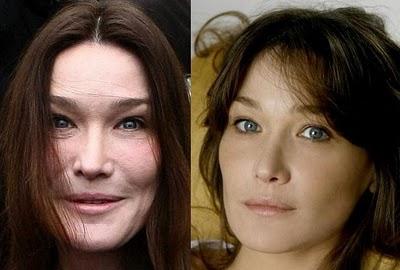 Carla Bruni plastic surgery