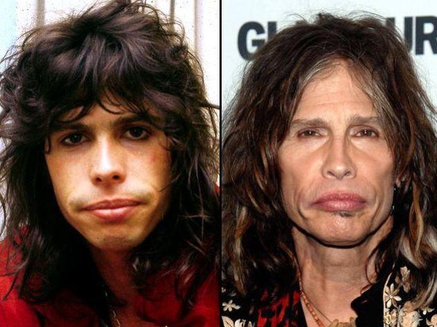 Steven Tyler plastic surgery