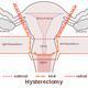 Removal of the Cervix during a Hysterectomy
