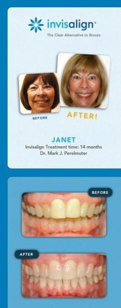 Before and After Invisalign