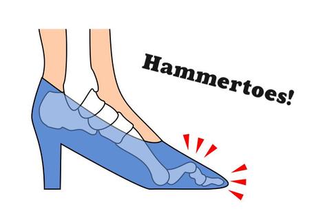 Hammertoes Cause and Cure