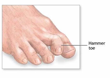 Hammertoe Illustration