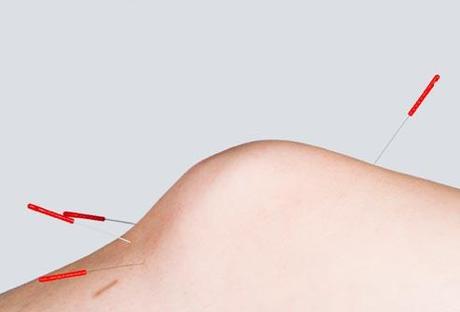 Acupuncture for Knee Pain