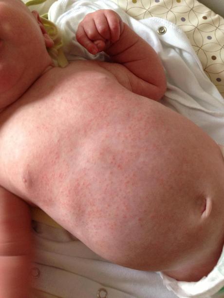 Five Week Old Constipated Baby + Chest Rash