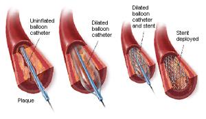 Stent