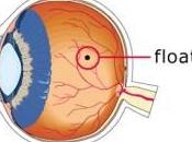 Floaters: Causes, Symptoms, Treatment
