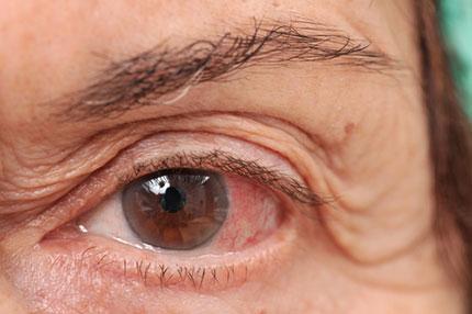 Eye Floaters: Causes, Symptoms, and Treatment Eye Floaters Causes and Symptoms