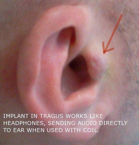 invisible-headphones-implant
