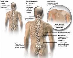 My Fight with Idiopathic Scoliosis