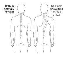 My Fight with Idiopathic Scoliosis