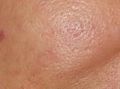 Oily/Sensitive Skin Summer Monsoon Details Pores, Crow's Feet, Wrinkles