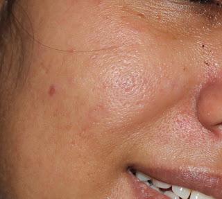 My Oily/Sensitive Skin in Summer and Monsoon - Details of Pores, Crow's Feet, Wrinkles