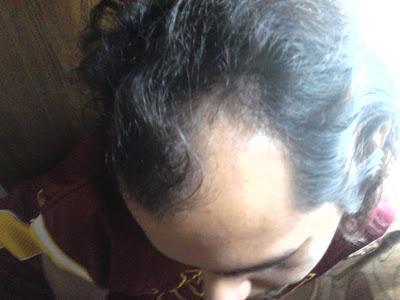 My Husbands Hair Growth Journey 2