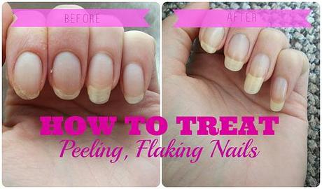 Free Health Tips | Good Nutrition | Healthy Diet Child: Peeling Nails ...