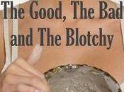 Acne: Good, Blotchy