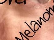 Nora, Melanoma Year Later