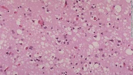 This tissue slide shows sponge-like lesions in the brain tissue of a classic CJD patient. This lesion is typical of many prion diseases.