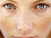 Freckles Melasma