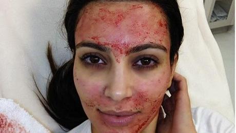 Weird Beauty Secrets : Kim Kardashian's Bloody Vampire Facial