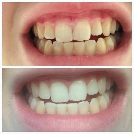 Teeth whitening: does it work?