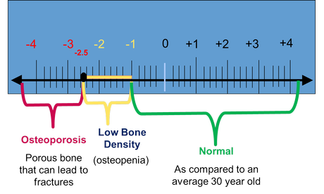 What Is Osteopenia?