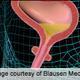 The Types of Urinary Incontinence