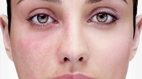 Is It Rosacea Or Just Redness?