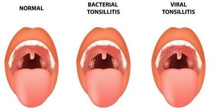 What are the causes of Tonsillitis?