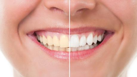 6 Dos and Don’ts of Teeth-Whitening
