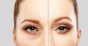 5 Ways a Blepharoplasty Can Make You Look Good