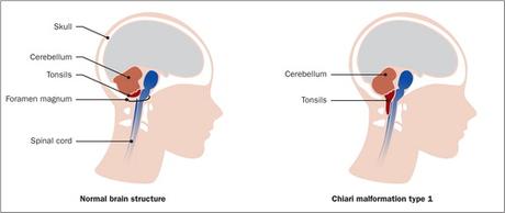 chiari malformation