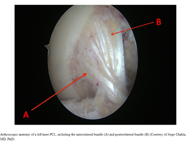 PCL Sprain: Your Complete Guide