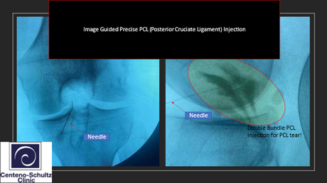 PCL Sprain: Your Complete Guide