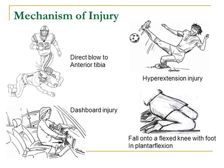 PCL Sprain: Your Complete Guide