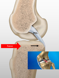 PCL Sprain: Your Complete Guide