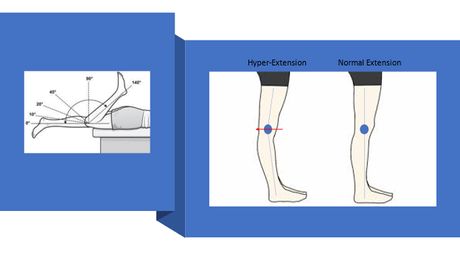 Knee Hyperextension – Symptoms, Causes, Prevention & Treatment Options