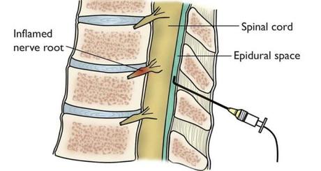 Increased Pain after Cervical Epidural Steroid Injection: A Quickstart Guide