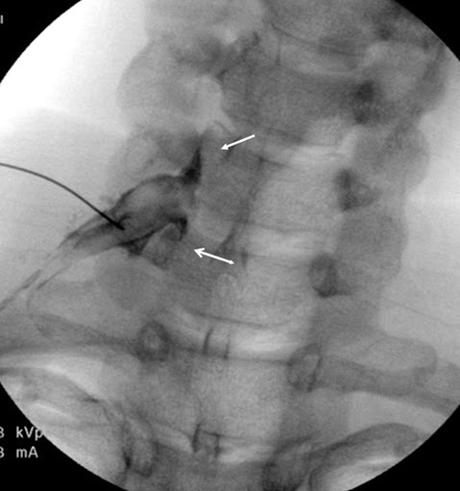 Increased Pain after Cervical Epidural Steroid Injection: A Quickstart Guide