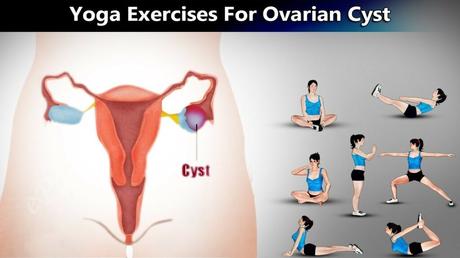 YOGA ASANAS AND PRANAYAM TO PREVENT OVARIAN CYSTS